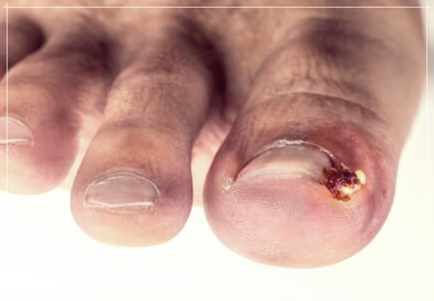 발톱 두꺼워지는 원인과 대처법