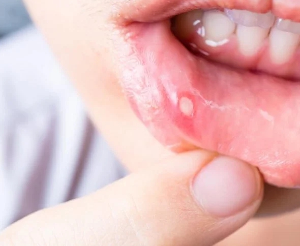 혓바늘 없애는 방법