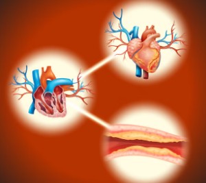 심근경색-초기-증상-5