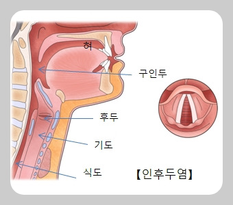 인후통