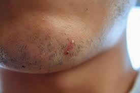 피부발진의 종류