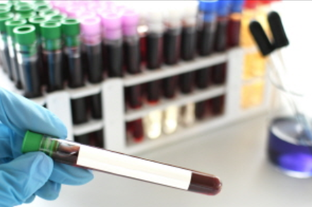 백내장 수술 비용 완벽정리