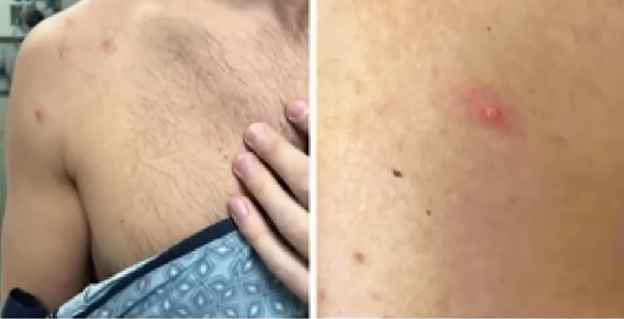 원숭이두창 증상