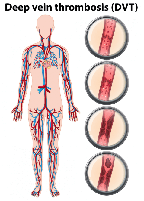 혈관의 지꺼기 농도