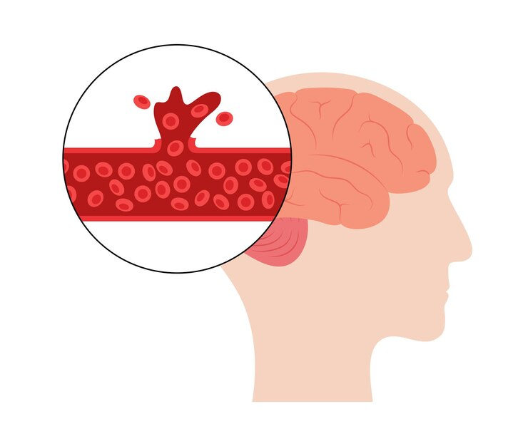 뇌출혈 전조증상 5가지 후유증 골든타임 원인 증상 회복 기간