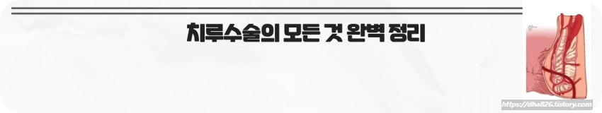 치루수술의 모든 것 완벽 정리