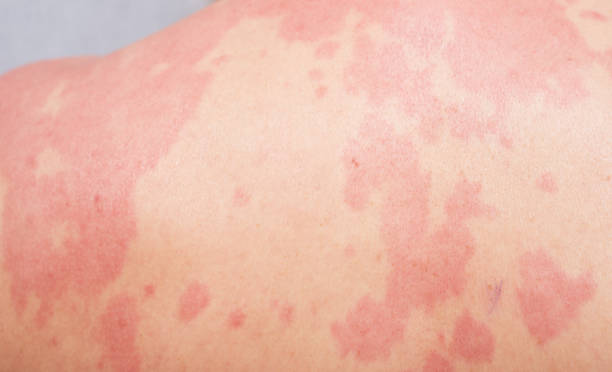 알레르기성 두드러기에 피해야 할 보습 성분 TOP 5