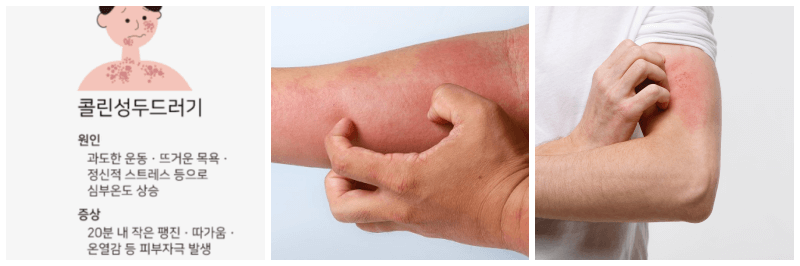 콜린성 두드러기 사진 3개