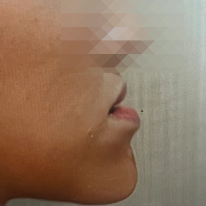 주걱턱-교정이-필요한-여성의-모습