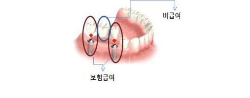 임플란트 건강보험
