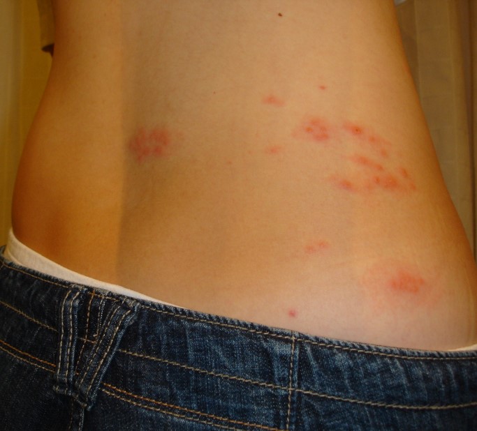 대상포진 예방접종