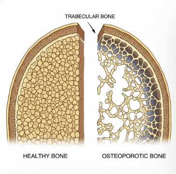 골다공증 영양제 추천 순위1