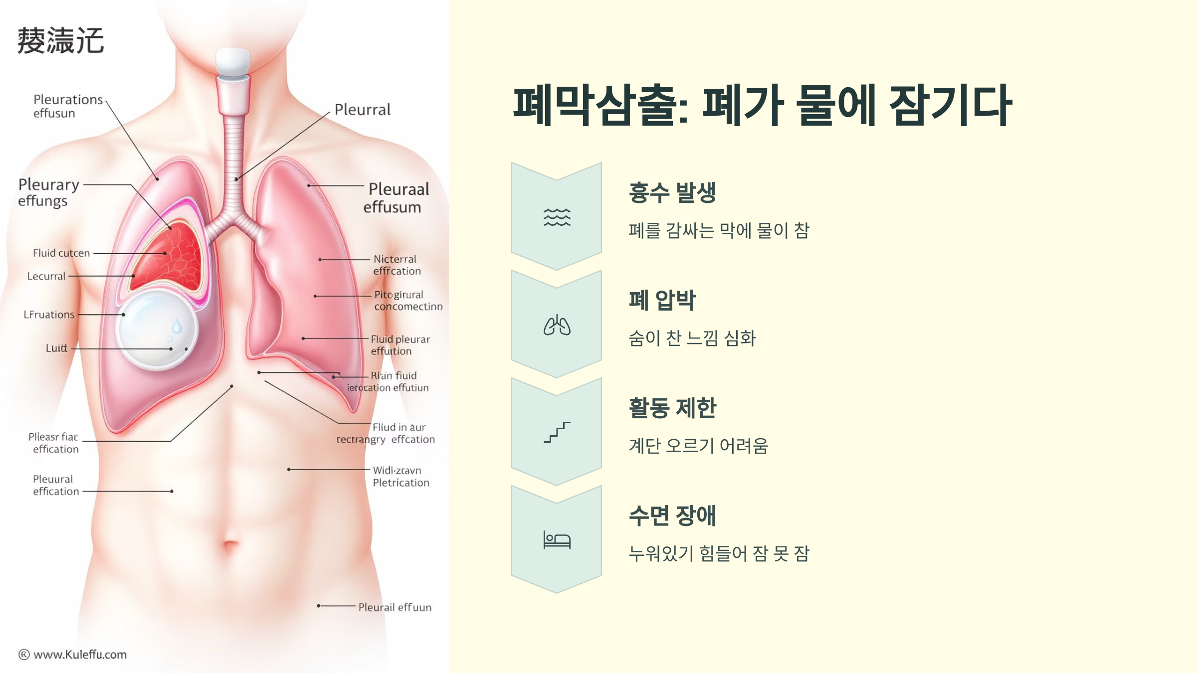 폐막삼출: 폐가 물에 잠기다