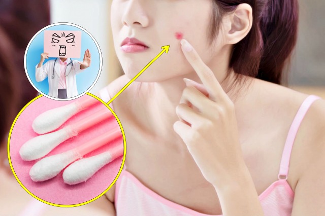 여드름,여드름흉터,면봉,피부 좋아지는 방법,피부 좋아지는 습관,피부관리,피부과쌤이 알려준