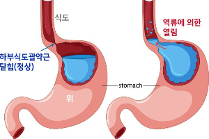 역류성 식도염 이미지2
