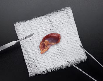 신장암 초기증상 3