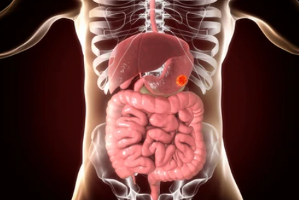 위암 4기 생존율