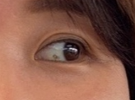 결막모반 제거 후기