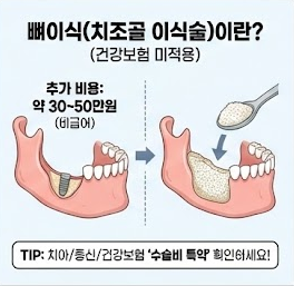 임플란트 가격 비교 뼈이식