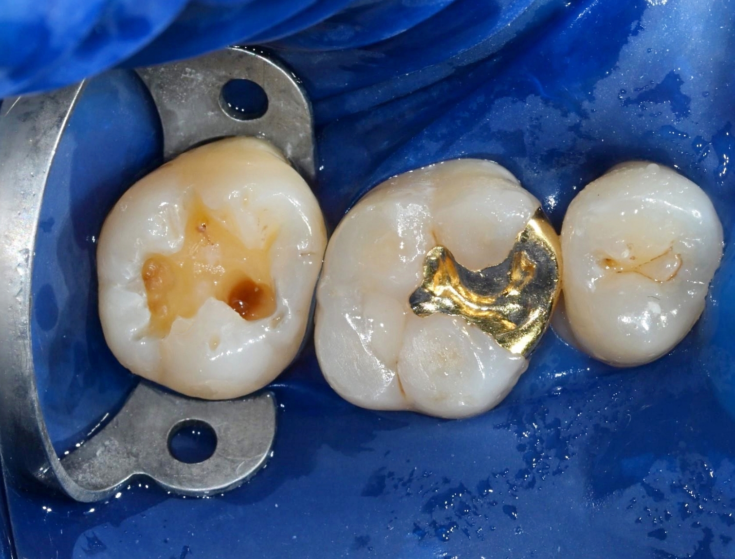 러버댐을 철저히 장착한 후 오염된 기존 보철물을 제거하고 내부의 깊은 충치를 깨끗하게 파낸 치아 내부 모습