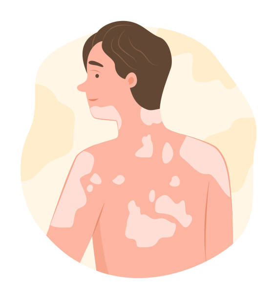 얼굴 백반증 치료방법, 최신 피부과 가이드