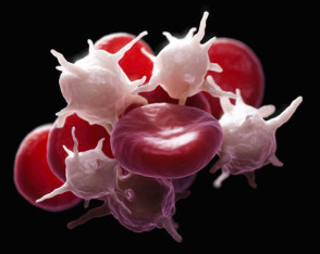 헤파린 유도 혈소판감소증(HIT) 진단 알고리듬