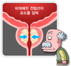 전립선 비대증 원인