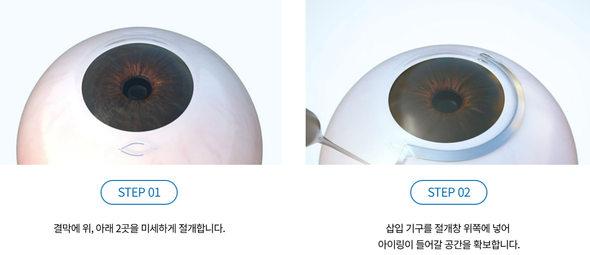 아이링수술, 아이링수술후기, 써클렌즈 대체, 눈동자확대수술, 미용성형, 안과 시술, 렌즈부작용