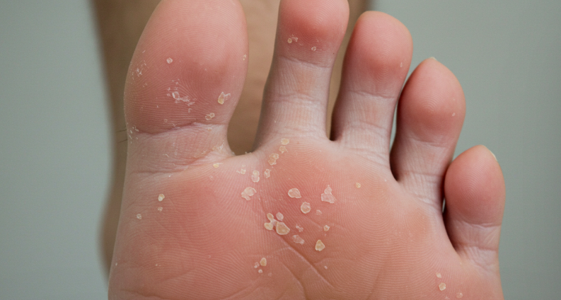 여름철 발 냄새, 무좀이 심해지는 이유