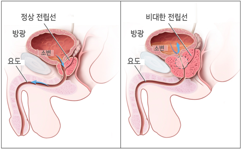 전립선 비대증