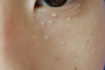 비립종 생기는 이유 비립종 없애는 방법 피부 관리법_23