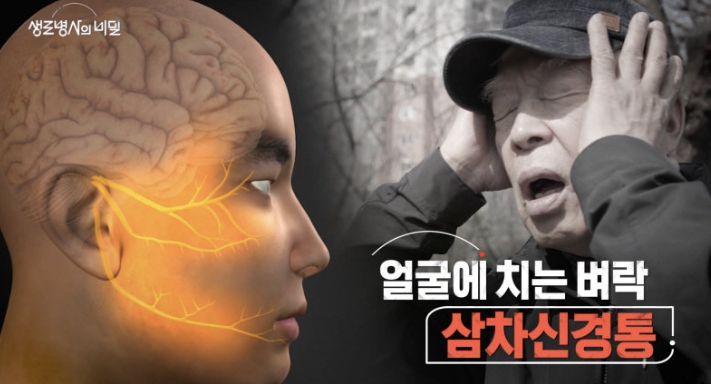 삼차신경통