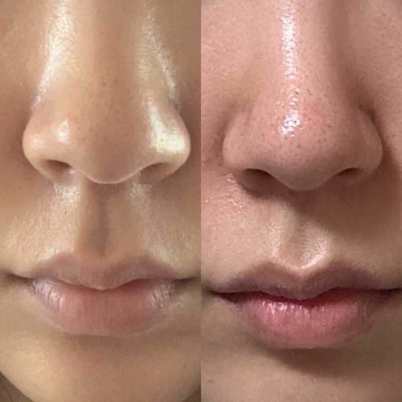 콧볼 보톡스 후기