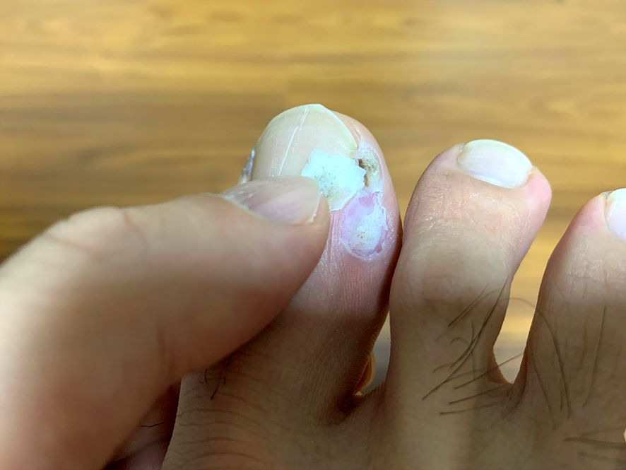 엄지발가락 족저사마귀 치료과정