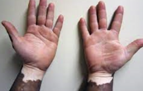 백반증 초기증상 10가지 총정리 섬네일