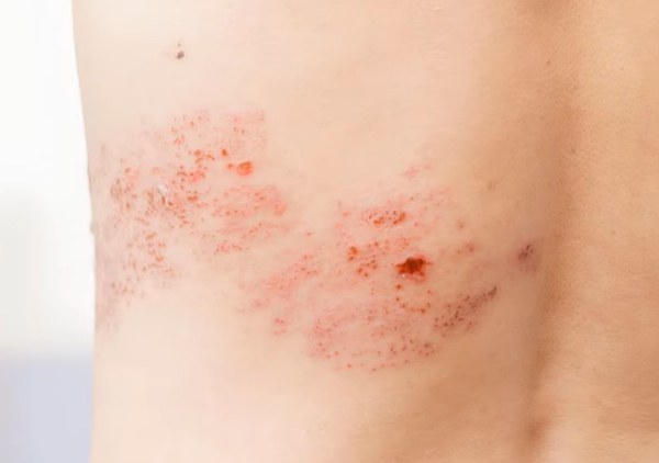 아시클로버 연고 효능