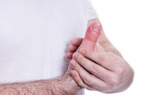 손 거스러미 해결 방법