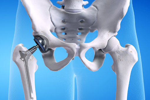 고관절 치환술
