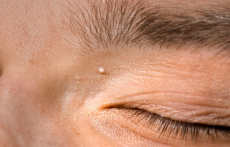 비립종 원인 생기는 이유 5가지