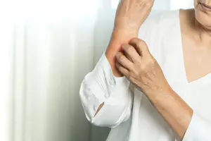 두드러기-치료방법