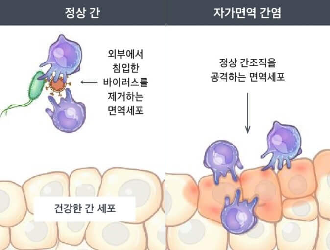 자가면역 간염