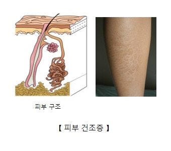 이유없이 가려운 증상, 피부 가려움 원인과 치료 방법