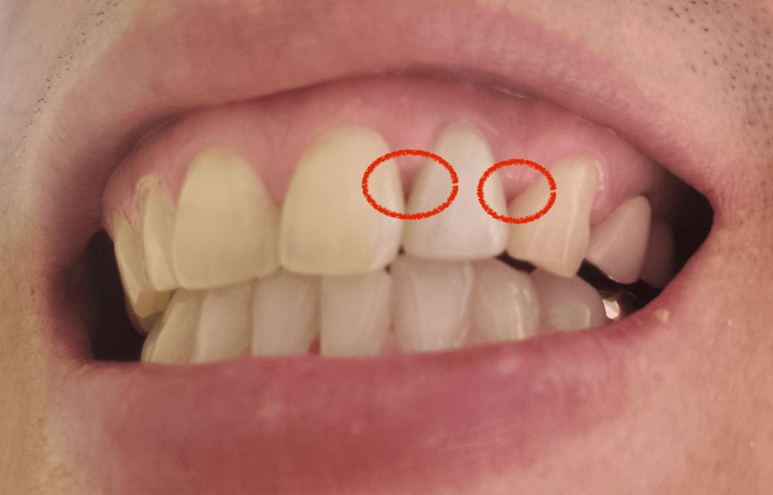 치근단절제술 부작용