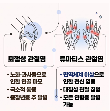 손가락 관절염 치료법