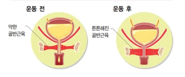 방광염 초기증상