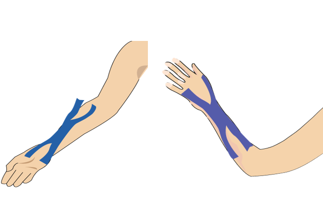 수근관 증후군을 동반한 손목 통증