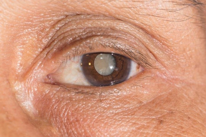 백내장 자주 묻는 질문