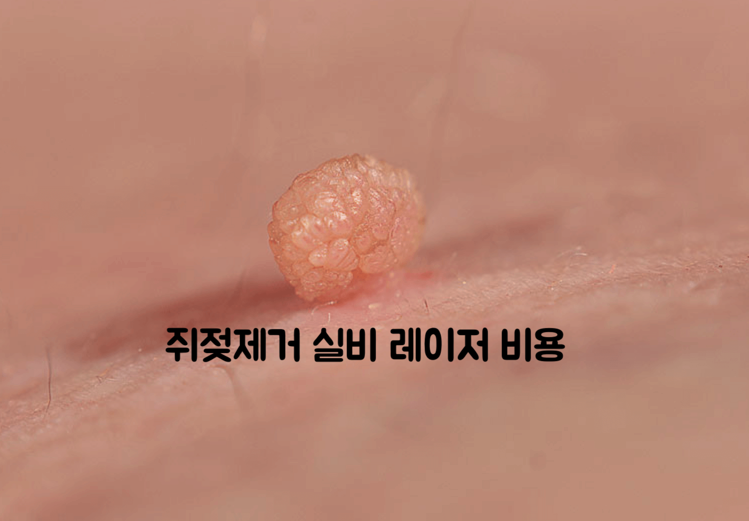 쥐젖제거
