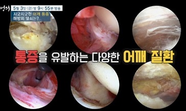 통증유발-어깨질환