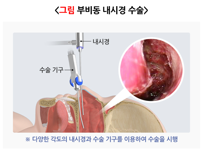 축농증수술